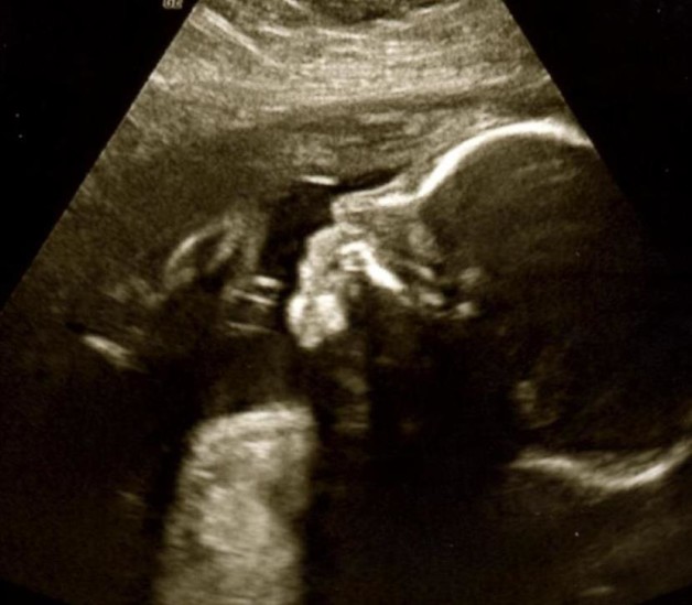 24-week ultrasound 1 - blog