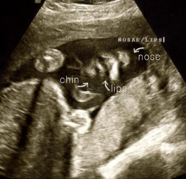 24-week ultrasound 3 - blog